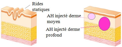 Schéma de l'injection de l'acide hyaluronique