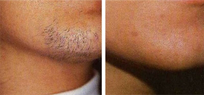 Epilation laser de la barbe
