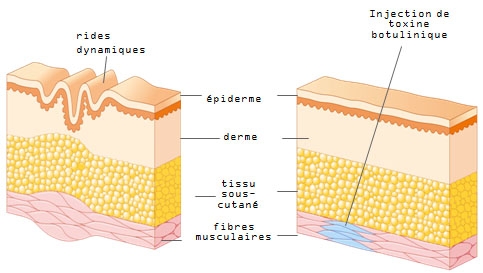 Schéma de l'injection du Botox