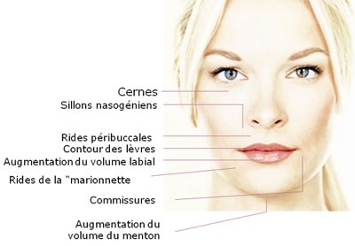 Les rides traitées par l'acide hyaluronique