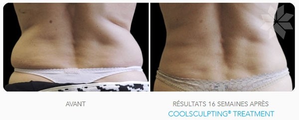 Suppression des poignées d'amour par Cryolipolyse Coolsculpting