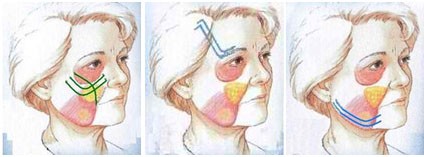 Le positionnement des fils tenseurs sur le visage Le positionnement des fils tenseurs sur le visage